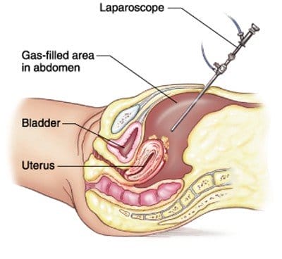 Laparoscopic Surgery Cost In Gurgaon