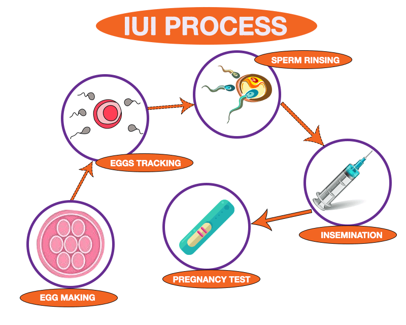 IUI procedure in Philippines 