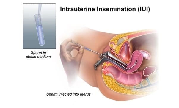 IUI Treatment Cost in gurgaon 2020